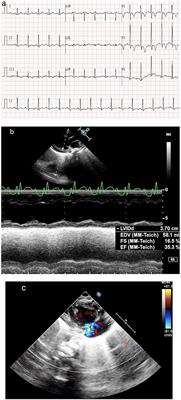 Extracorporeal Membrane Oxygenation Support for Cardiac Dysfunction Due to Kawasaki Disease Shock Syndrome